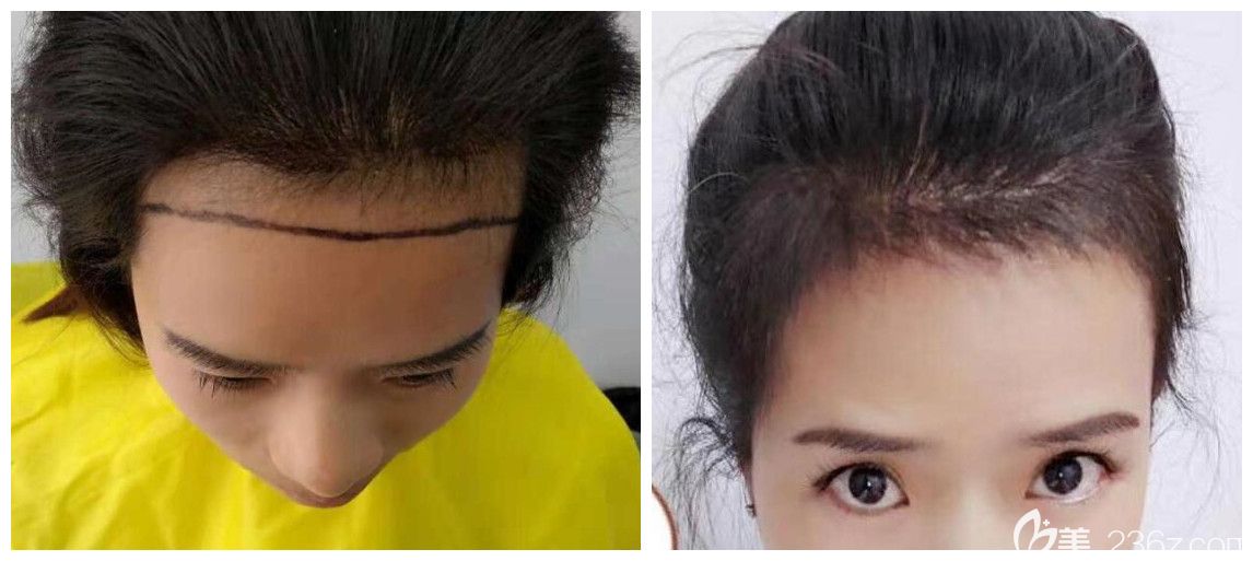 合肥植发医院哪个好?公布合肥壹美尚方蜜女性发际线种植案例 合肥植发医院哪个好?公布合肥壹美尚方蜜女性发际线种植案例