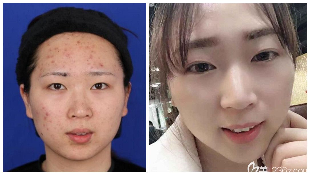 3月女神节合肥壹美尚超低折扣价格表上线，蜂巢皮秒首次体验仅需1980元/双眼皮+开眼角低至3800元