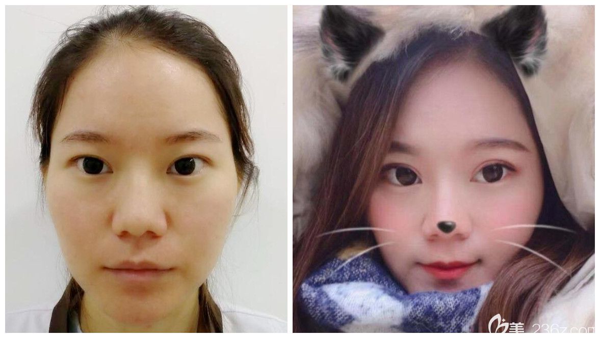 合肥哪里割双眼皮好?合肥壹美尚双眼皮案例一览 合肥哪里割双眼皮好?合肥壹美尚双眼皮案例一览