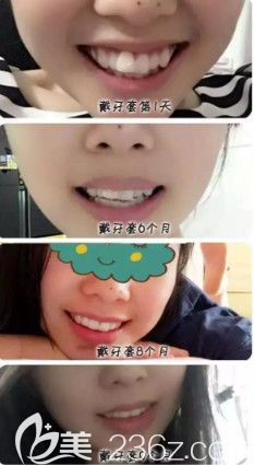 韩永刚医生做隐形矫正案例