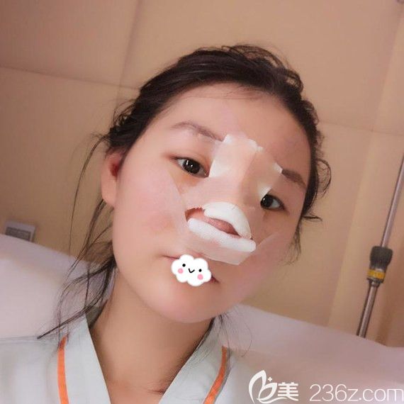 武汉艺星杨国梁假体隆鼻+耳软骨垫鼻尖案例 武汉艺星杨国梁假体隆鼻+耳软骨垫鼻尖案例