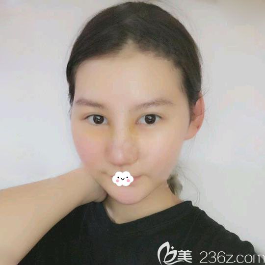 武汉艺星杨国梁隆鼻术后恢复图 武汉艺星杨国梁隆鼻术后恢复图