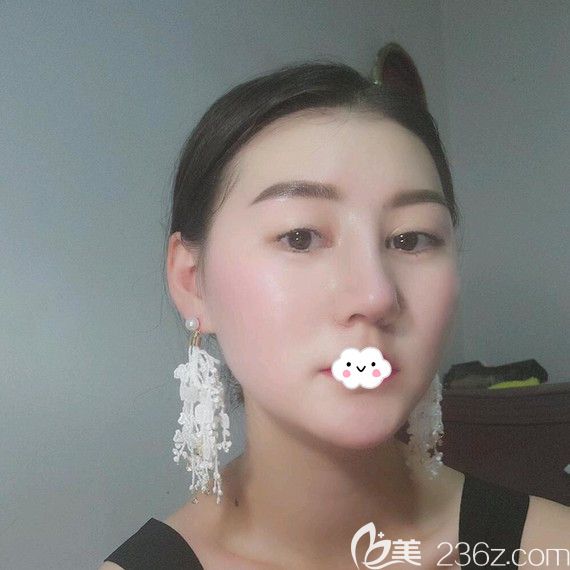 武汉艺星鼻综合效果怎么样?杨国梁案例 武汉艺星鼻综合效果怎么样?杨国梁案例