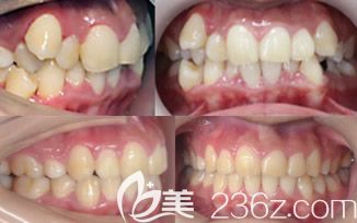 格伦菲尔口腔周道平医生牙齿矫正案例 格伦菲尔口腔周道平医生牙齿矫正案例