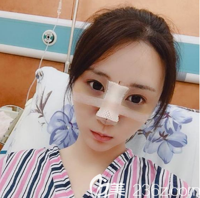佛山佳丽整形隆鼻术后两天