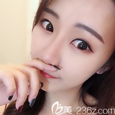 佛山佳丽整形做隆鼻子效果怎么样
