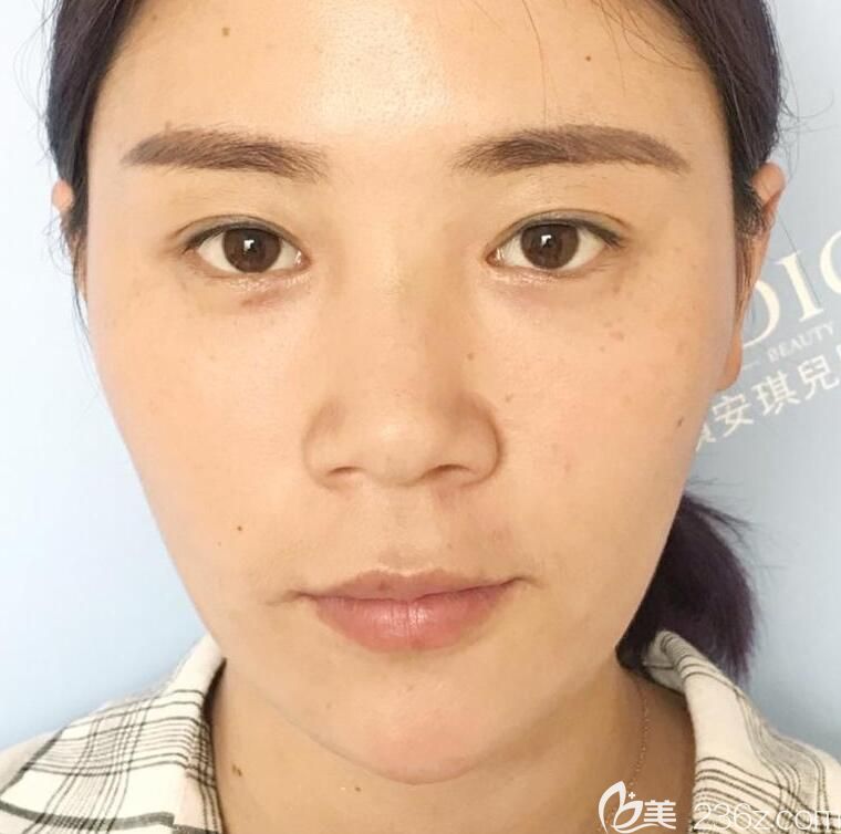 去合肥白领安琪儿隆鼻术前 去合肥白领安琪儿隆鼻术前