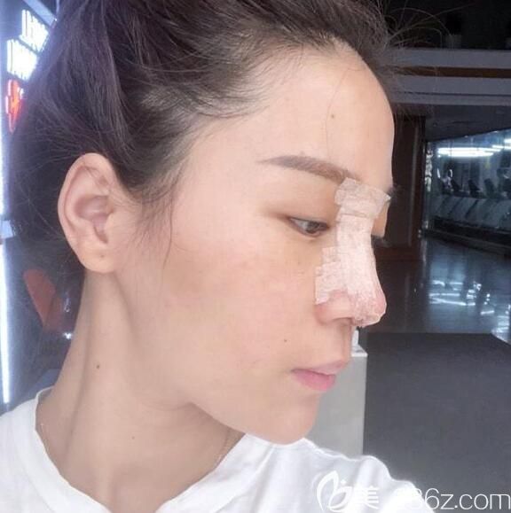 找胡准做假体隆鼻+耳软骨垫鼻尖术后天 找胡准做假体隆鼻+耳软骨垫鼻尖术后天