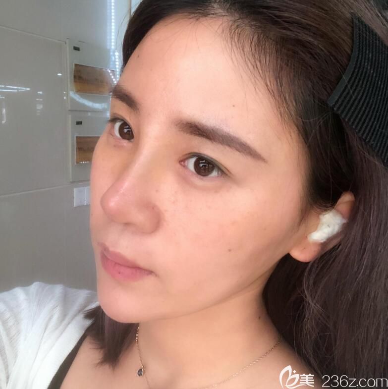 合肥安琪儿鼻综合隆鼻术后第5天情况 合肥安琪儿鼻综合隆鼻术后第5天情况