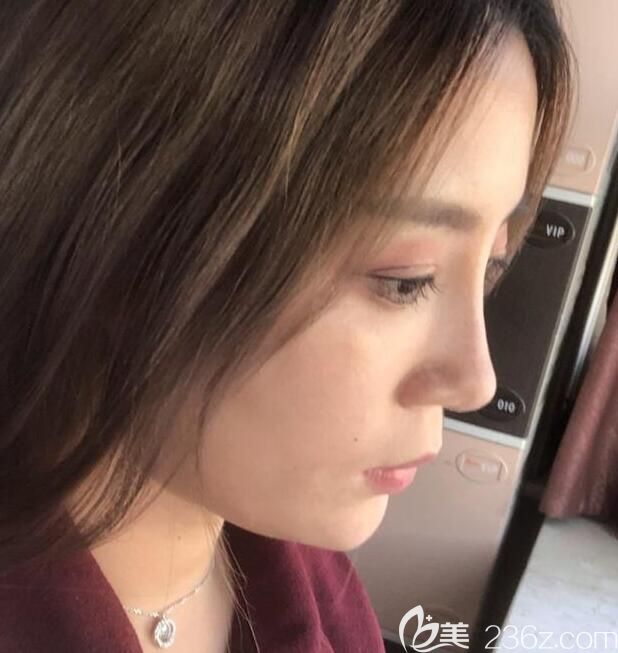 安琪儿假体隆鼻鼻综合术后第7天图 安琪儿假体隆鼻鼻综合术后第7天图
