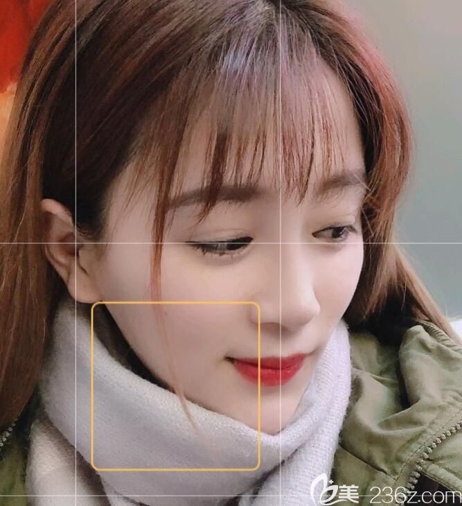 我找合肥白领安琪儿胡准院长做韩式生科二段加耳软骨隆鼻