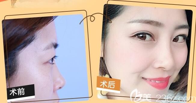 合肥鼻综合哪家好?白领安琪儿胡准鼻综合隆鼻案例效果一览 合肥鼻综合哪家好?白领安琪儿胡准鼻综合隆鼻案例效果一览