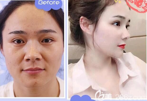 合肥安琪儿全脸埋线提升案例 合肥安琪儿全脸埋线提升案例