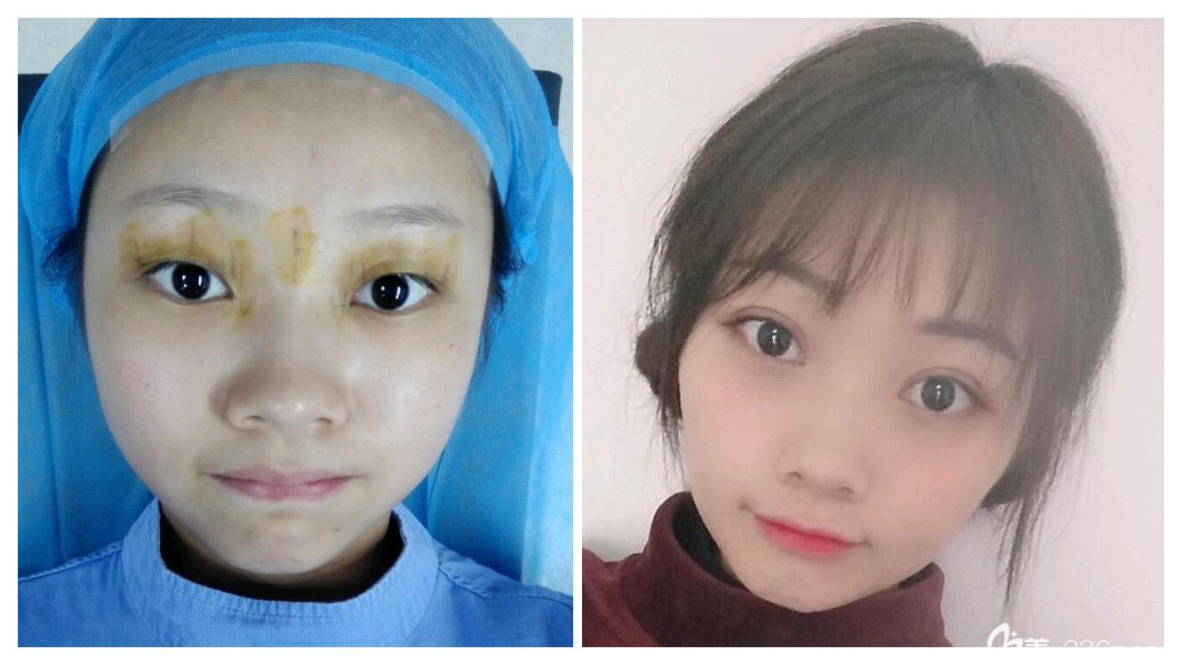 合肥哪里割双眼皮好?合肥白领安琪儿眼综合案例效果对比图 合肥哪里割双眼皮好?合肥白领安琪儿眼综合案例效果对比图
