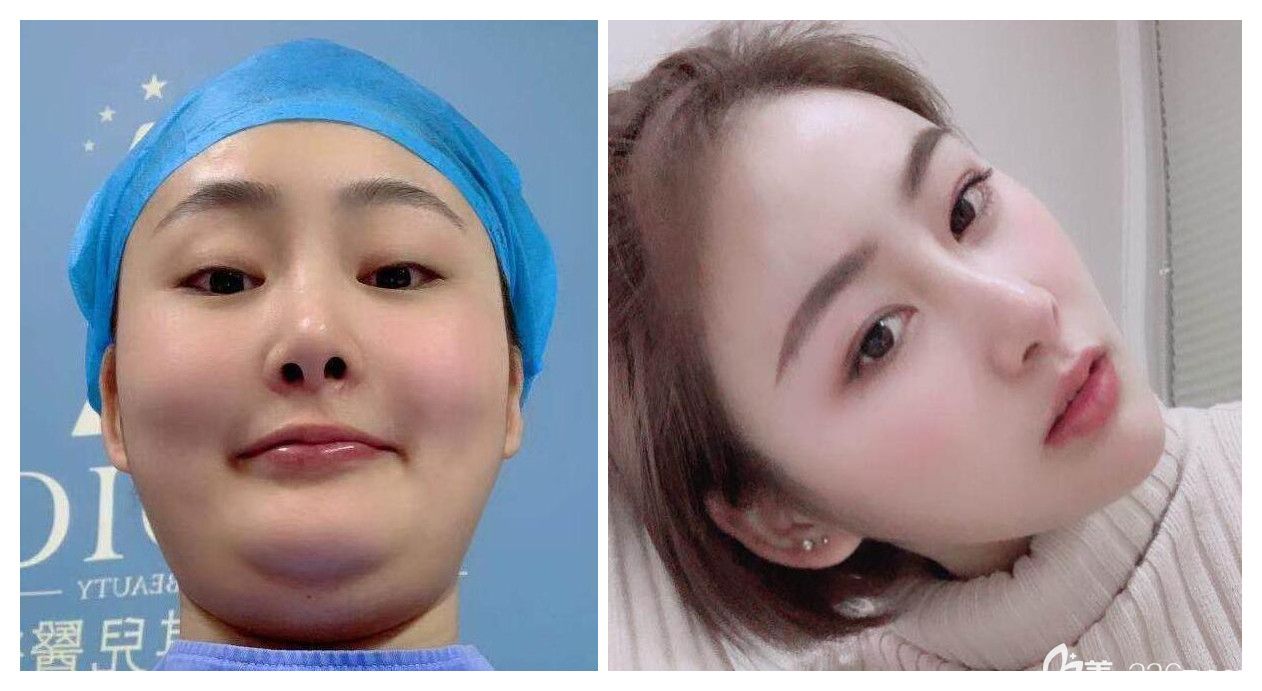 合肥白领安琪儿面部抽脂对比照 合肥白领安琪儿面部抽脂对比照