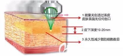 百嘉丽超声溶脂作用原理