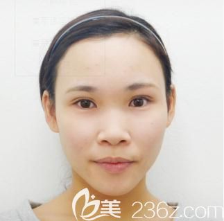 日本十仁做假体隆鼻加耳软骨垫鼻尖前 日本十仁做假体隆鼻加耳软骨垫鼻尖前