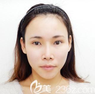 日本十仁做假体隆鼻加耳软骨垫鼻尖术后一个月 日本十仁做假体隆鼻加耳软骨垫鼻尖术后一个月