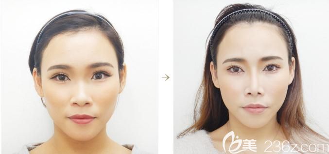 日本十仁做假体隆鼻加耳软骨垫鼻尖手术前后对比 日本十仁做假体隆鼻加耳软骨垫鼻尖手术前后对比