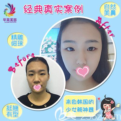 华美整形医院隆鼻案例 华美整形医院隆鼻案例