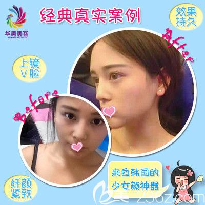 邯郸华美注射除皱案例 邯郸华美注射除皱案例