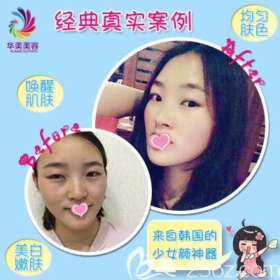 华美整形医院激光祛斑案例 华美整形医院激光祛斑案例