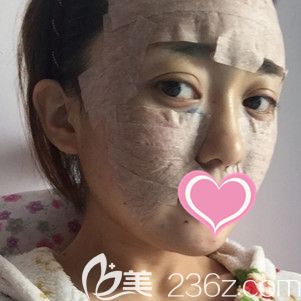 刘育凤主任做自体脂肪面部填充术后即刻