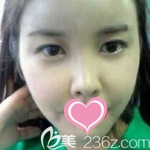 做自体脂肪全面部填充术后10天面部淤青肿胀消除