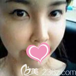 在上饶尚美整形做自体脂肪面部填充术后20天脂肪基本存活