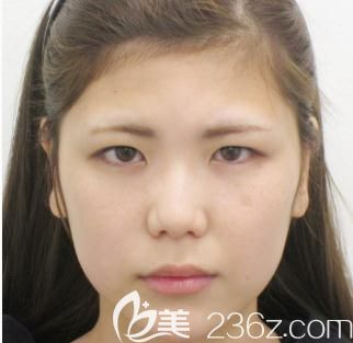 十仁美容找鸣海荣治做切开双眼皮前 十仁美容找鸣海荣治做切开双眼皮前