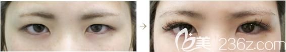 十仁美容找鸣海荣治做切开双眼皮前后对比 十仁美容找鸣海荣治做切开双眼皮前后对比