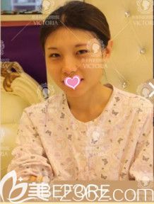 张立平院长为我做双眼皮术前是单眼皮小眼睛 张立平院长为我做双眼皮术前是单眼皮小眼睛