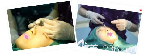 张立平院长为我做双眼皮手术中 张立平院长为我做双眼皮手术中