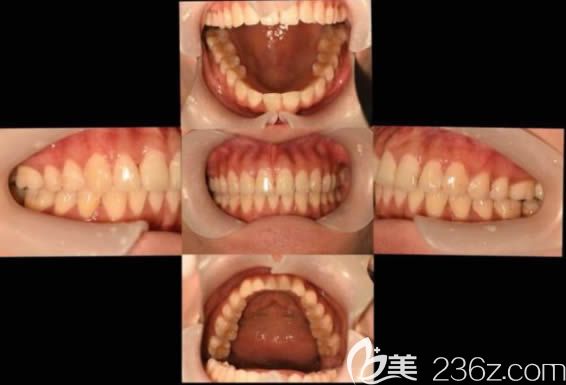 佩戴隐形牙套两年多后的效果