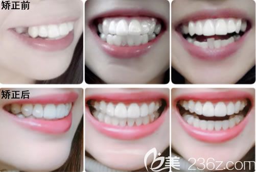 天津美奥高医生26岁顾客龅牙矫正前后对比效果
