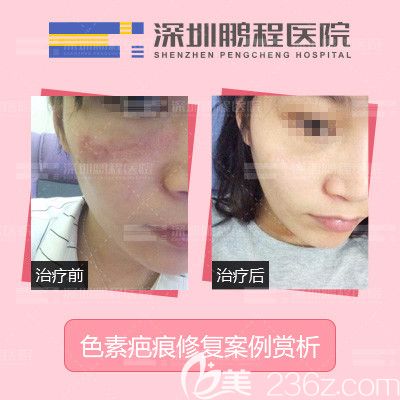 深圳鹏程医院像素疤痕修复案例 深圳鹏程医院像素疤痕修复案例