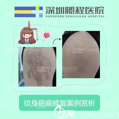 深圳鹏程医院纹身疤痕修复案例