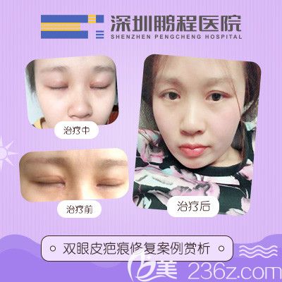 深圳鹏程医院吕美琪主任双眼皮疤痕修复案例