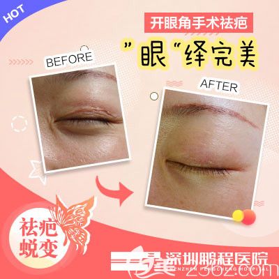 深圳鹏程医院吕美琪做的开眼角手术疤痕修复案例 深圳鹏程医院吕美琪做的开眼角手术疤痕修复案例