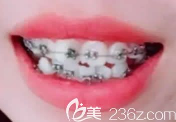 女儿在深圳格伦菲尔口腔刚开始做牙齿矫正 女儿在深圳格伦菲尔口腔刚开始做牙齿矫正