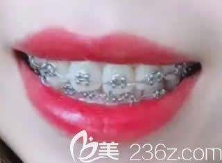 孩子在深圳格伦菲尔口腔做金属托槽矫正第6个月 孩子在深圳格伦菲尔口腔做金属托槽矫正第6个月