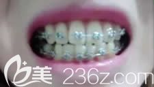 10岁的女儿在格伦菲尔口腔做牙齿矫正第3个月 10岁的女儿在格伦菲尔口腔做牙齿矫正第3个月