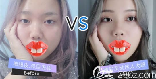厦门陈运生全切双眼皮7mm一年后对比照片 厦门陈运生全切双眼皮7mm一年后对比照片