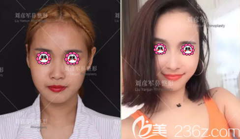 北京沃尔整形医院冯雁平肋软骨鼻综合整形<span style= 北京沃尔整形医院冯雁平肋软骨鼻综合整形<span style=