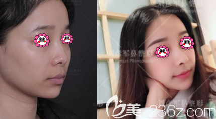 北京沃尔医疗美容赵丹医生硅胶假体隆鼻<span style= 北京沃尔医疗美容赵丹医生硅胶假体隆鼻<span style=