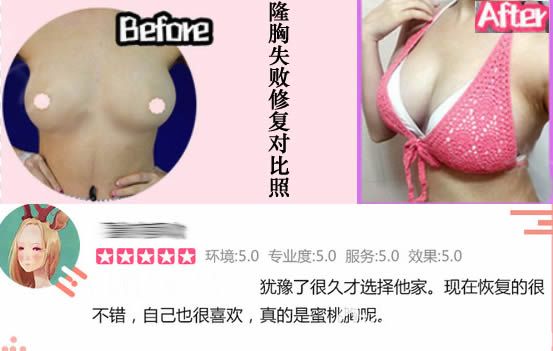 厦门华美贾虹医生假体隆胸失败修复案例图 厦门华美贾虹医生假体隆胸失败修复案例图