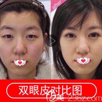 张家口维多利亚双眼皮案例 张家口维多利亚双眼皮案例