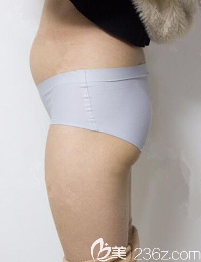 腰腹环吸前照片 腰腹环吸前照片