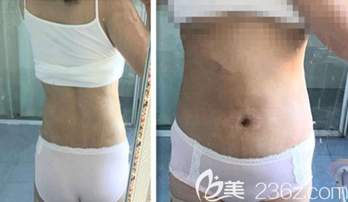 吸脂第20天照片 吸脂第20天照片