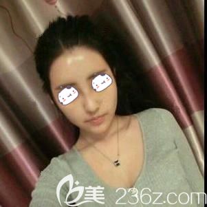 做自体脂肪面部填充术后10天脸部肿胀消除针孔消失 做自体脂肪面部填充术后10天脸部肿胀消除针孔消失